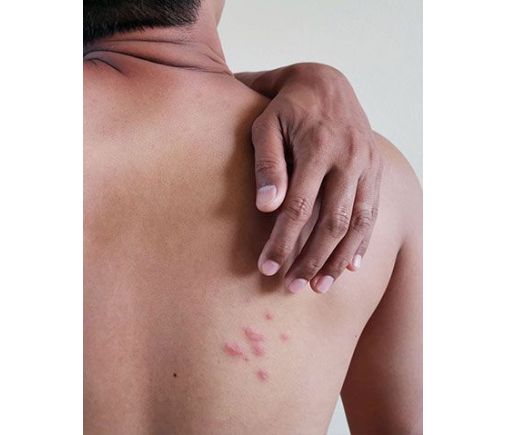 Man reaching over his shoulder to touch a rash on his back.