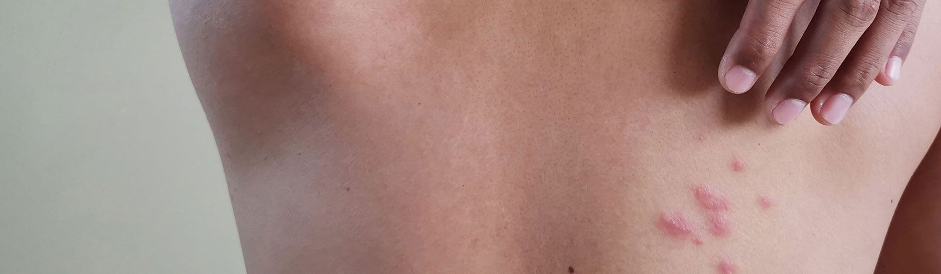Man reaching over his shoulder to touch a rash on his back.